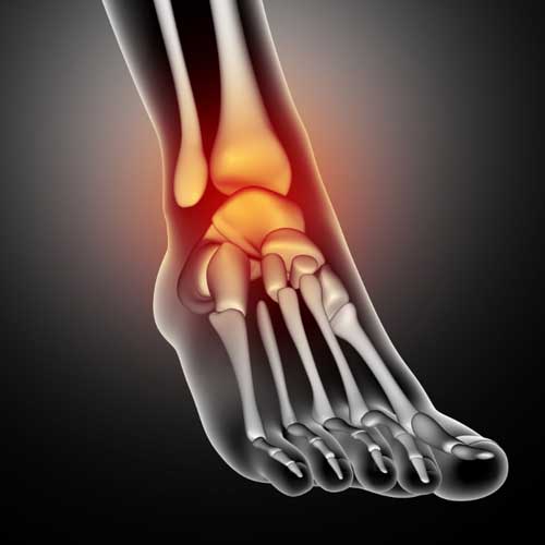 plntar Tendinosis Treatment Tendinosis Treatment,Chronic Tendon pain,Tenotomy Procedure in Hazlet,Innovative Treatment for Tendon Conditions,Effective Outpatient Treatment for Chronic Tendinopathy Tenotomy NJ